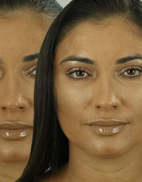 Melasma: como maquiar as manchas